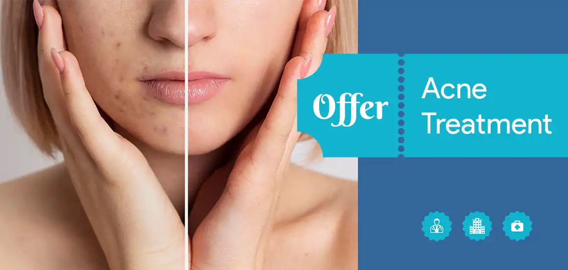 acne treatment 20percent off